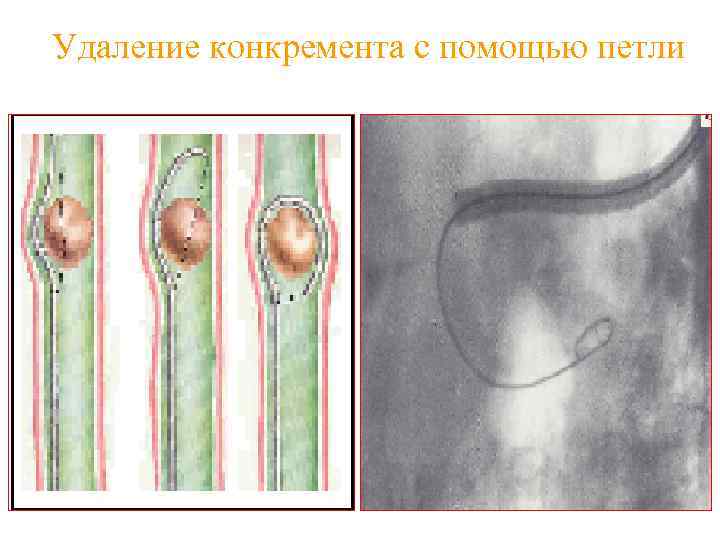 Удаление конкремента с помощью петли 