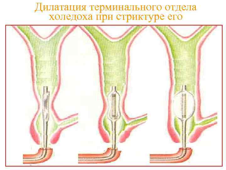 Дилатация терминального отдела холедоха при стриктуре его 