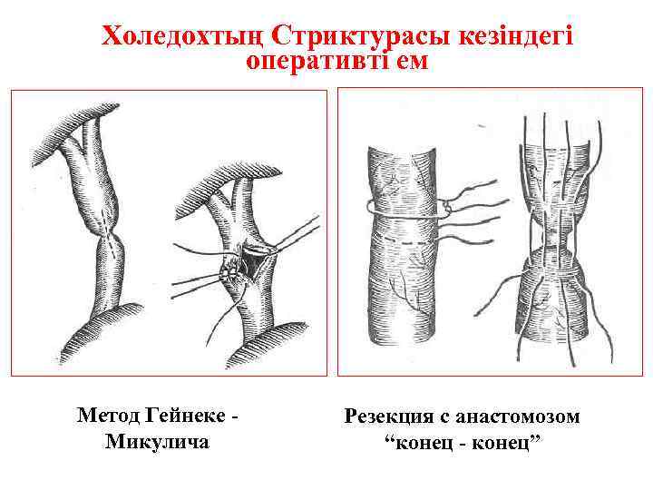Холедохтың Стриктурасы кезіндегі оперативті ем Метод Гейнеке Микулича Резекция с анастомозом “конец - конец”