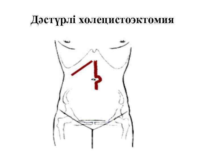 Дәстүрлі холецистоэктомия 