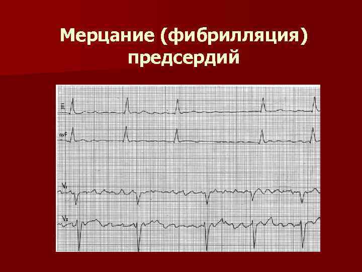 Мерцание на экг. Ритм фибрилляции предсердий ЭКГ. Трепетание и фибрилляция предсердий на ЭКГ. Фибрилляция предсердий на ЭКГ. ЭКГ при мерцании и трепетании предсердий.