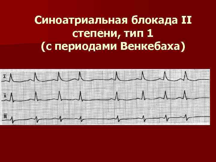 Синоатриальная блокада II степени, тип 1 (с периодами Венкебаха) 