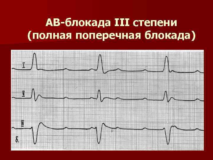 Экг ав. Полная атриовентрикулярная блокада 3 степени на ЭКГ. Полная АВ блокада 3 степени ЭКГ. Полная поперечная АВ блокада на ЭКГ. АВ блокада 3 ст на ЭКГ.