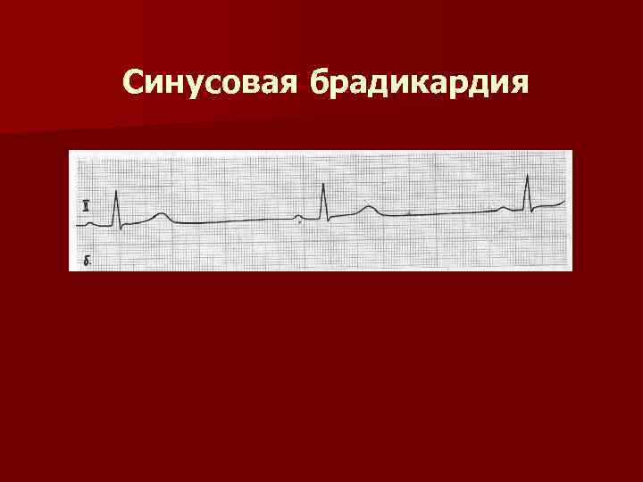 Синусовая брадикардия неполная. Переходная зона при синусовой брадикардии. Мягкий систолический шум при синусовой брадикардии.