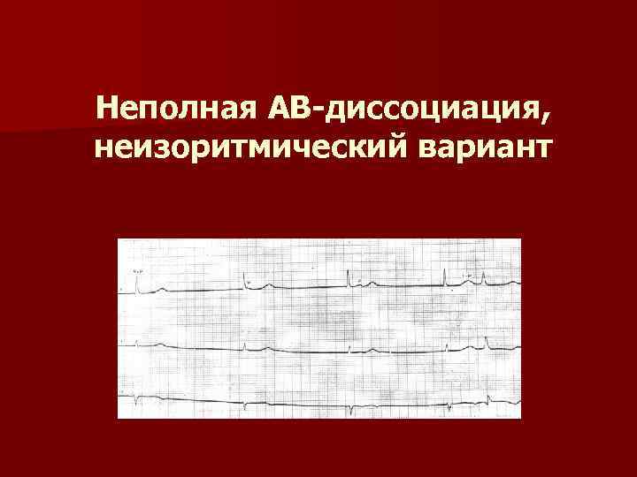 Неполная АВ-диссоциация, неизоритмический вариант 