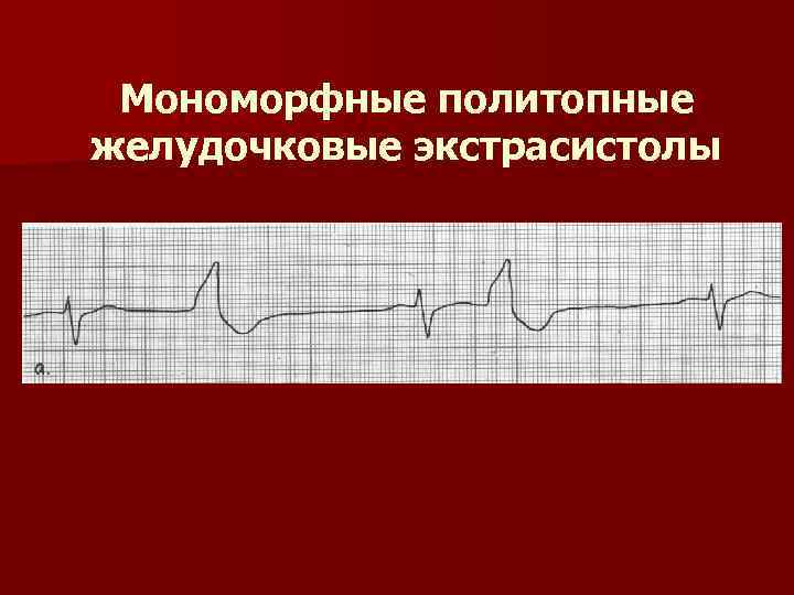 Мономорфные политопные желудочковые экстрасистолы 