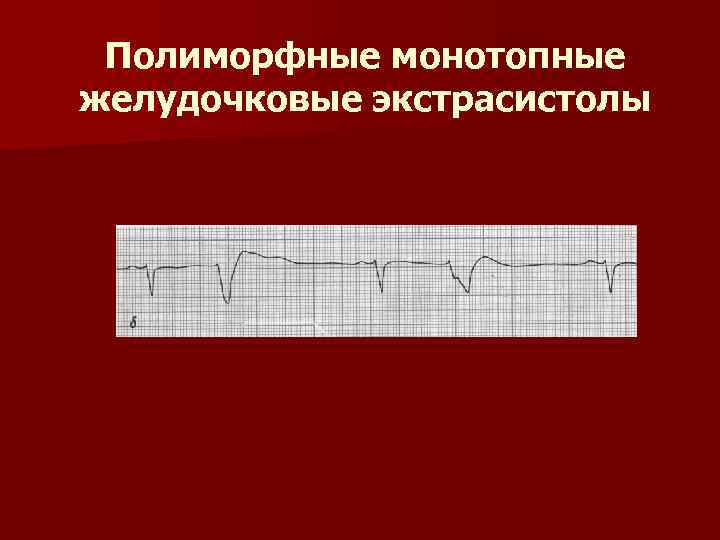 Полиморфные монотопные желудочковые экстрасистолы 