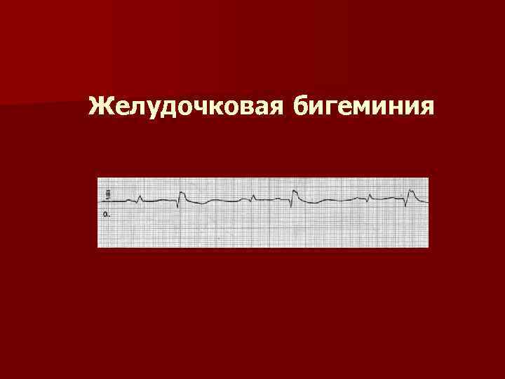 Нарушение ритма по типу бигеминии карта вызова