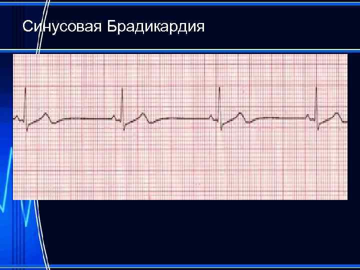 Синусовая Брадикардия 