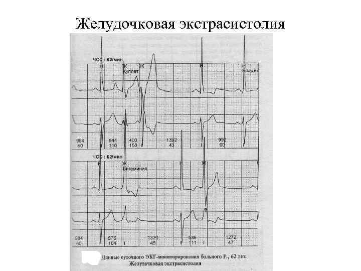 Желудочковая экстрасистолия 