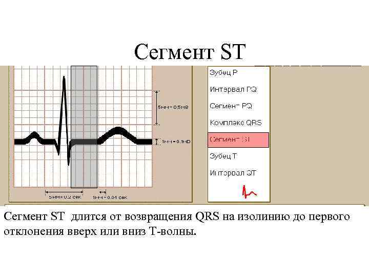 Сегмент ST длится от возвращения QRS на изолинию до первого отклонения вверх или вниз