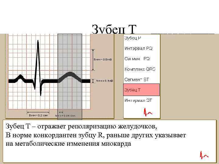Зубец Т – отражает реполяризацию желудочков, В норме конкордантен зубцу R, раньше других указывает