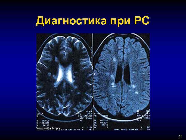 Диагностика при РС 21 