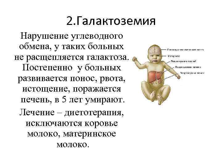 Галактоземия презентация по генетике