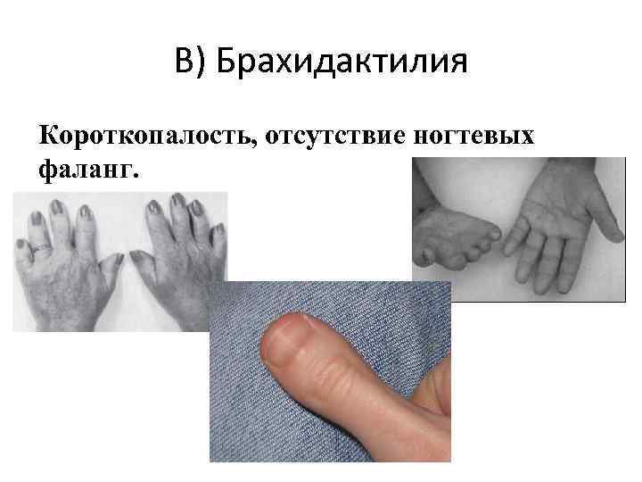 В) Брахидактилия Короткопалость, отсутствие ногтевых фаланг. 