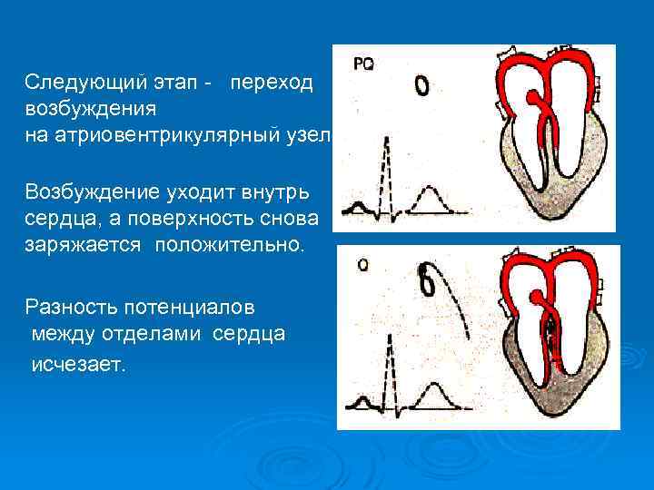 Следующий этап - переход возбуждения на атриовентрикулярный узел. Возбуждение уходит внутрь сердца, а поверхность