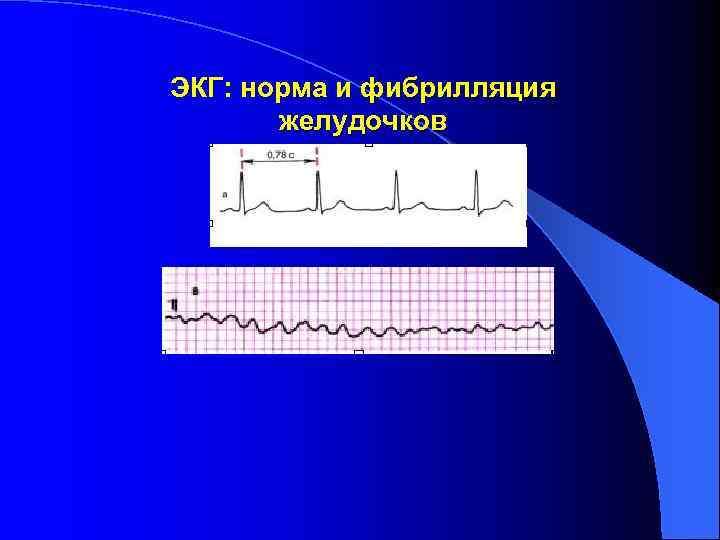 ЭКГ: норма и фибрилляция желудочков 