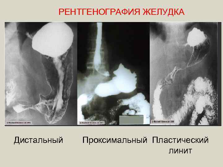 РЕНТГЕНОГРАФИЯ ЖЕЛУДКА Дистальный Проксимальный Пластический линит 