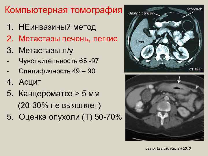 Компьютерная томография 1. НЕинвазиный метод 2. Метастазы печень, легкие 3. Метастазы л/у - Чувствительность