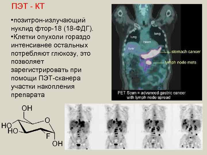 ПЭТ - КТ • позитрон-излучающий нуклид фтор-18 (18 -ФДГ). • Клетки опухоли гораздо интенсивнее