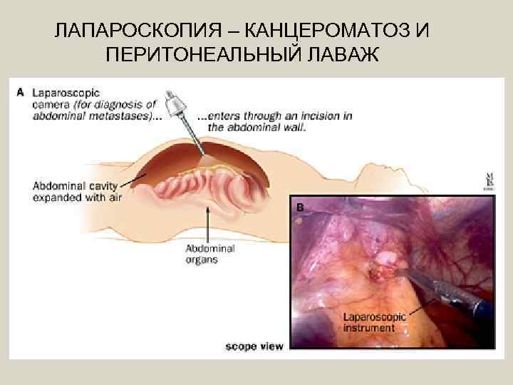 ЛАПАРОСКОПИЯ – КАНЦЕРОМАТОЗ И ПЕРИТОНЕАЛЬНЫЙ ЛАВАЖ 