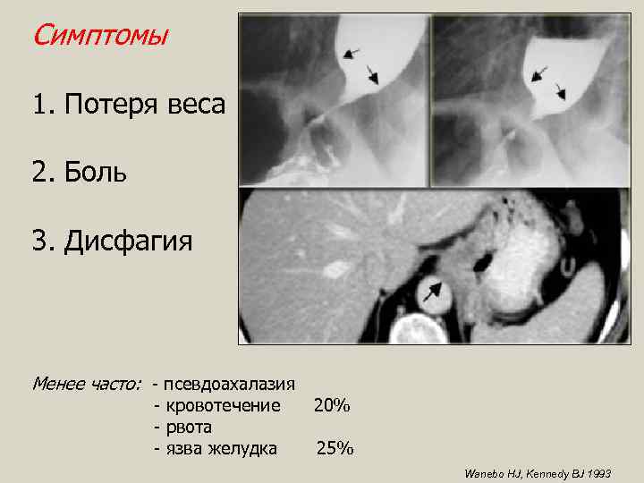 Симптомы 1. Потеря веса 2. Боль 3. Дисфагия Менее часто: - псевдоахалазия - кровотечение