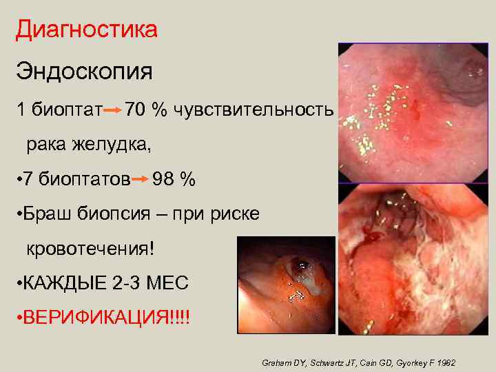 Диагностика Эндоскопия 1 биоптат 70 % чувствительность рака желудка, • 7 биоптатов 98 %