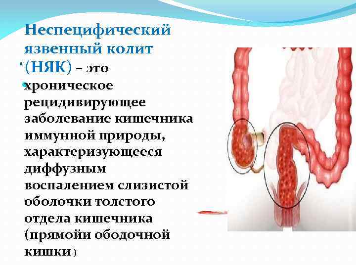 Неспецифический язвенный колит . (НЯК) – это . хроническое рецидивирующее заболевание кишечника иммунной природы,