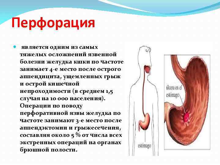 Перфорация является одним из самых тяжелых осложнений язвенной болезни желудка кшки по частоте занимает