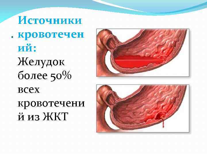 . Источники кровотечен ий: Желудок более 50% всех кровотечени й из ЖКТ 