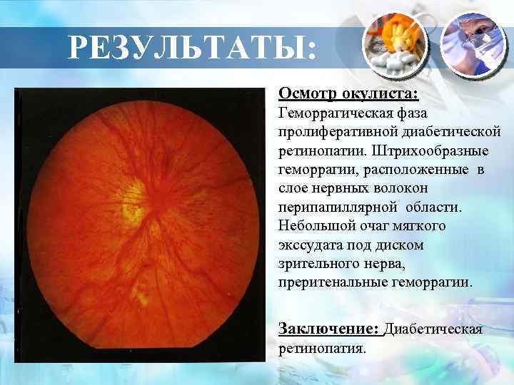 РЕЗУЛЬТАТЫ: Осмотр окулиста: Геморрагическая фаза пролиферативной диабетической ретинопатии. Штрихообразные геморрагии, расположенные в слое нервных