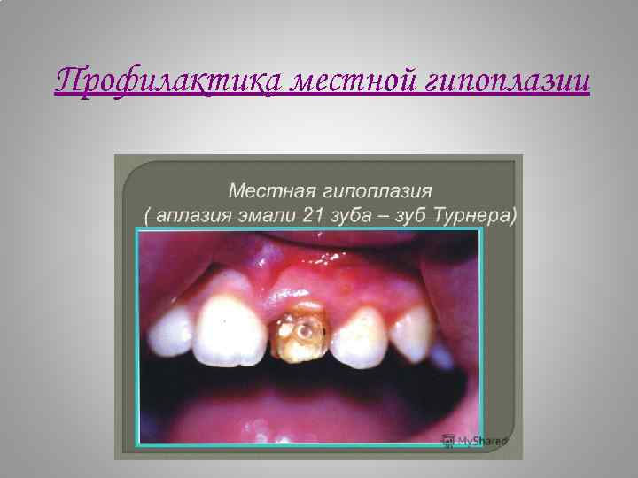 Презентация некариозные поражения твердых тканей зубов