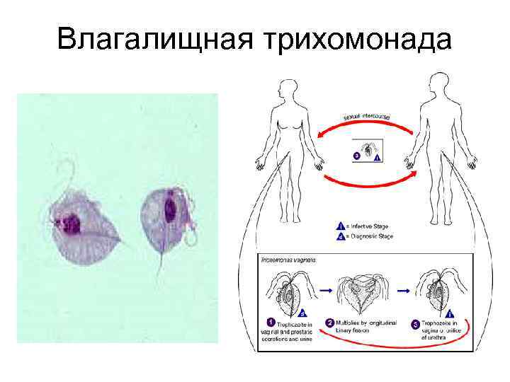 Влагалищная трихомонада 