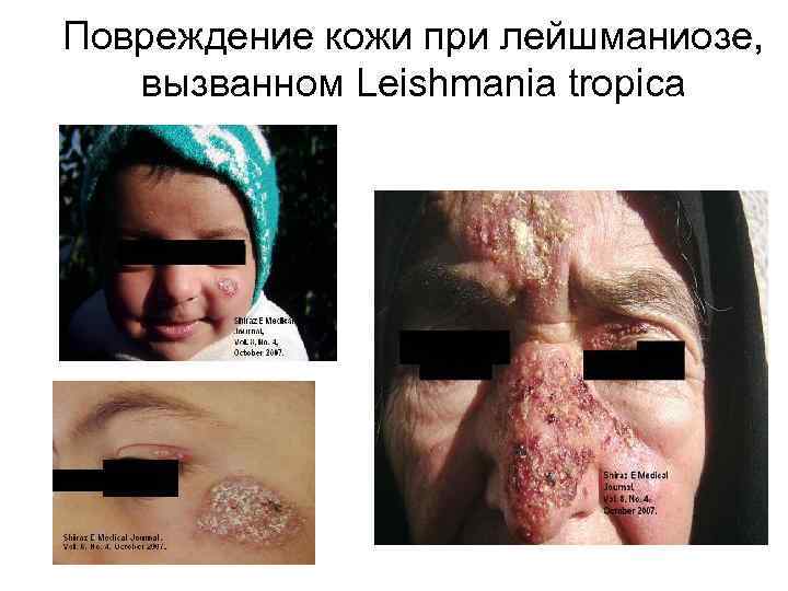 Повреждение кожи при лейшманиозе, вызванном Leishmania tropica 