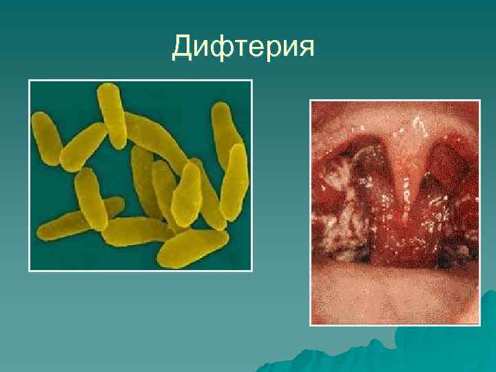 Дифтерия 