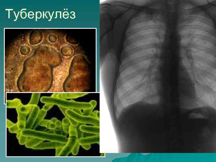 Туберкулёз Возбудительтуберкулезная бацилла 