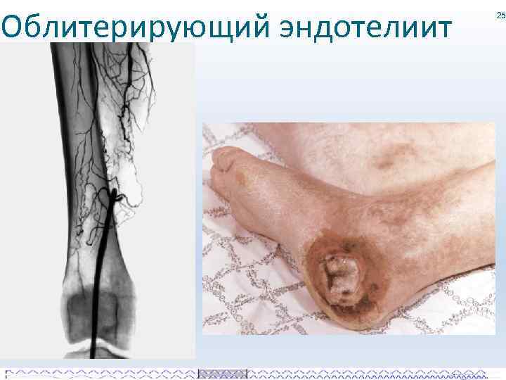 Облитерирующий эндотелиит 25 