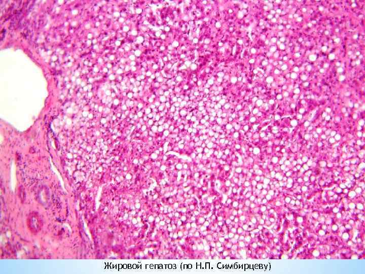 Жировой гепатоз (по Н. П. Симбирцеву) 