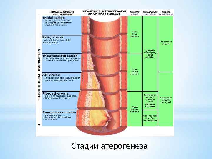 Стадии атерогенеза 