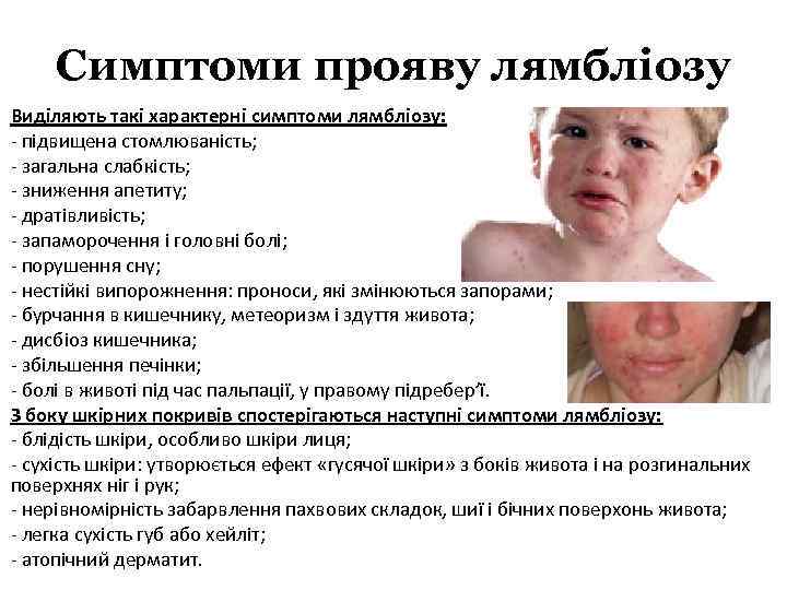 Симптоми прояву лямбліозу Виділяють такі характерні симптоми лямбліозу: - підвищена стомлюваність; - загальна слабкість;