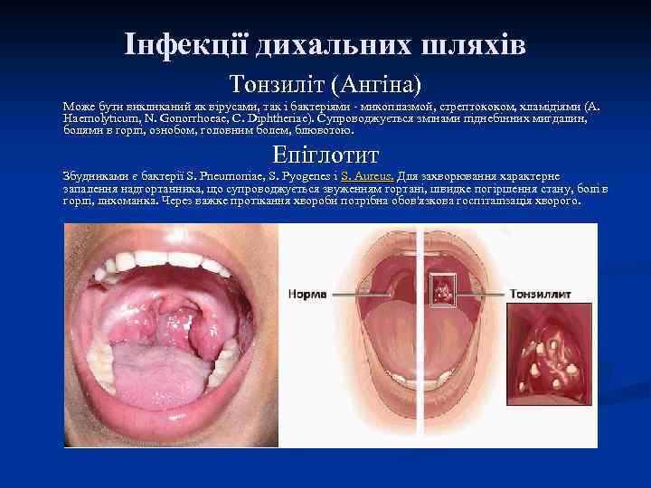 Інфекції дихальних шляхів Тонзиліт (Ангіна) Може бути викликаний як вірусами, так і бактеріями -