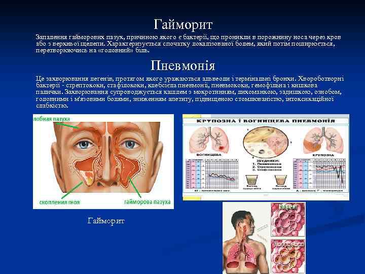 Гайморит Запалення гайморових пазух, причиною якого є бактерії, що проникли в порожнину носа через