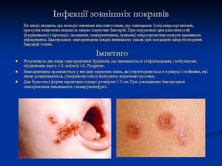 Інфекції зовнішніх покривів На шкірі людини, що володіє певними властивостями, що захищають її від
