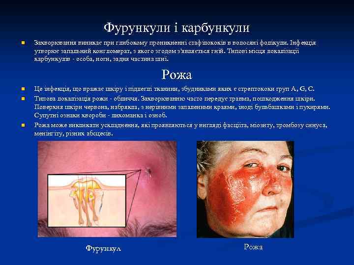 Фурункули і карбункули n Захворювання виникає при глибокому проникненні стафілококів в волосяні фолікули. Інфекція