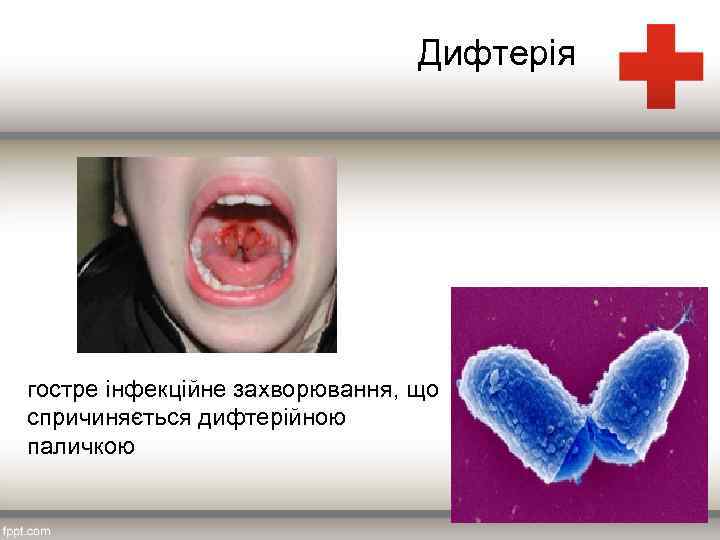 Дифтерія гостре інфекційне захворювання, що спричиняється дифтерійною паличкою 