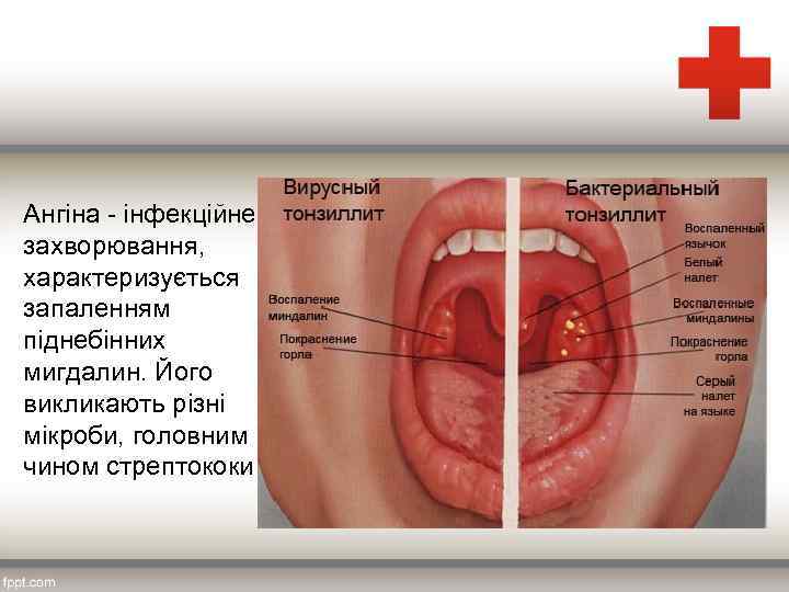 Ангіна інфекційне захворювання, характеризується запаленням піднебінних мигдалин. Його викликають різні мікроби, головним чином стрептококи