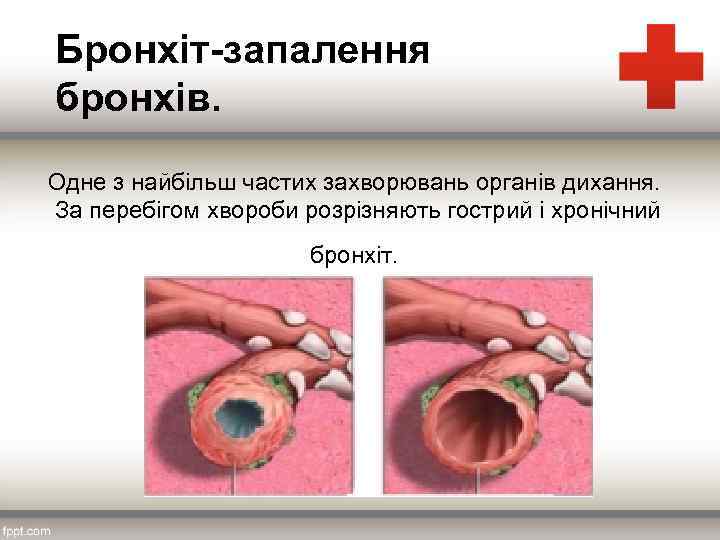 Бронхіт-запалення бронхів. Одне з найбільш частих захворювань органів дихання. За перебігом хвороби розрізняють гострий