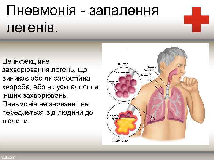 Пневмонія запалення легенів. Це інфекційне захворювання легень, що виникає або як самостійна хвороба, або