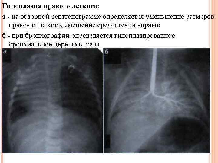 Гипоплазия легкого фото