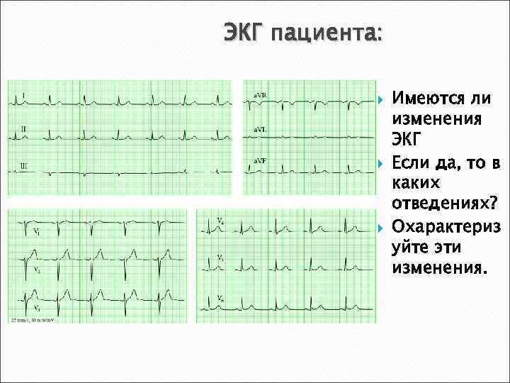 ЭКГ пациента: Имеются ли изменения ЭКГ Если да, то в каких отведениях? Охарактериз уйте